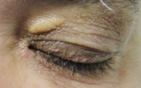 xantelasma palpebral